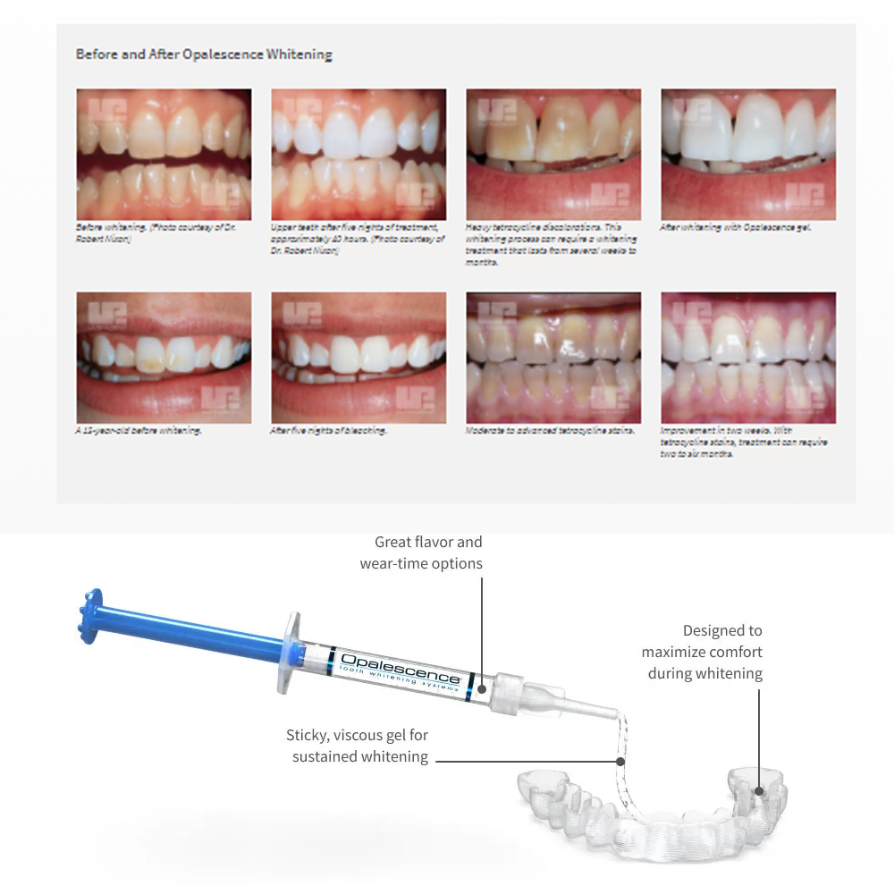 Отбеливающий набор opalution 2 – обзор и цена Teeth Whitening Near Me